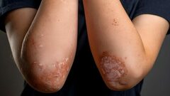 Divorce, Separation Might Increase Kids’ Risk Of Psoriasis