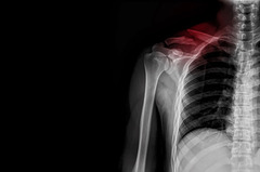 Broken Collarbone Hospitalizations Increase Among Children