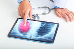 Tuberculosis Is Back on the Rise: What To Know About Symptoms and Treatment