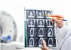 Under Current Guidelines, Most Lung Cancer Patients Weren't Eligible for Cancer Screening