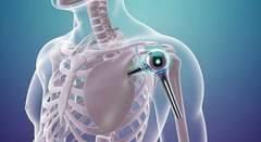 Obesity No Barrier For Shoulder Replacement Surgery, Study Finds